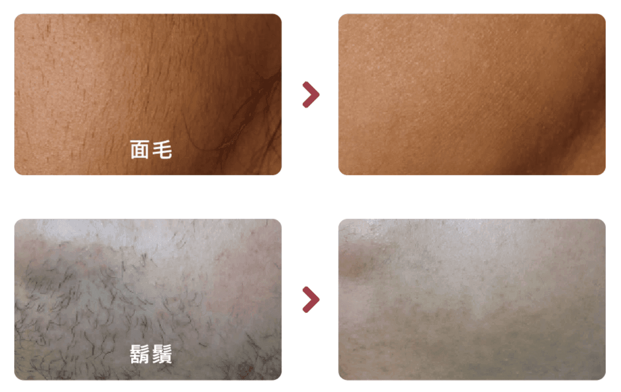 激光脫毛