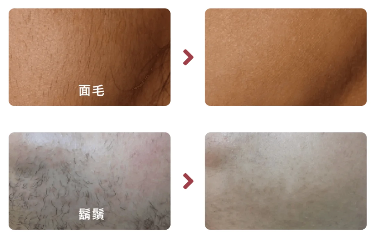 Lutronic Clarity II 智能激光脫毛 banner